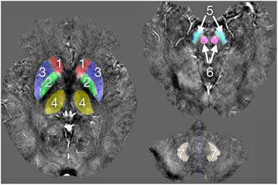 CAU-Net: A Deep Learning Method for Deep Gray Matter Nuclei Segmentation